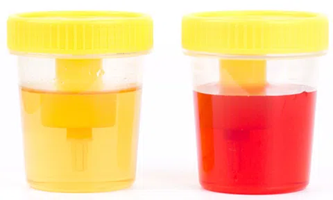 Những triệu chứng ung thư bàng quang, chớ coi thường!