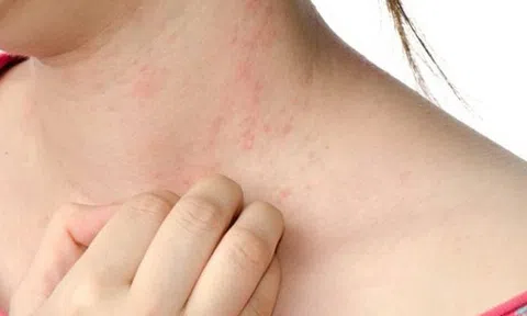 Cô gái 32 tuổi bị ung thư gan, hãi hùng khi bác sĩ chỉ ra 4 dấu hiệu này