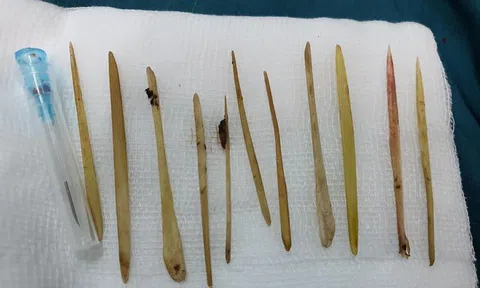 Nuốt 11 chiếc tăm lúc nhậu say, người đàn ông bị thủng ruột