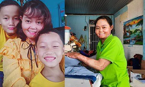 Hai năm hồi sinh của người vợ bị chồng thiêu sống bỏng đến 92% cơ thể
