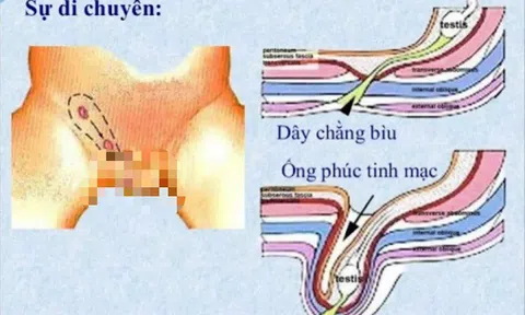 Căn bệnh nguy hiểm cứ 100 trẻ thì có đến 5 trẻ mắc, cha mẹ lại dễ bỏ qua