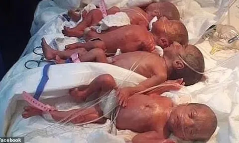 Bà mẹ trẻ 1 lần sinh 9 khiến các bác sĩ "tròn mắt"