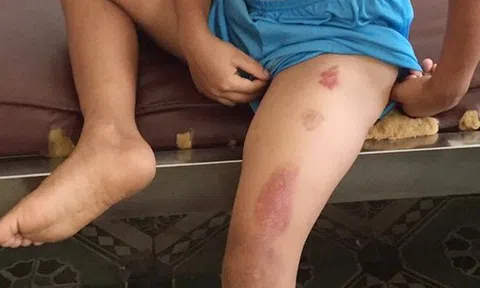 Bé trai 6 tuổi bị cha dượng bạo hành dã man, châm thuốc lá đang cháy vào người