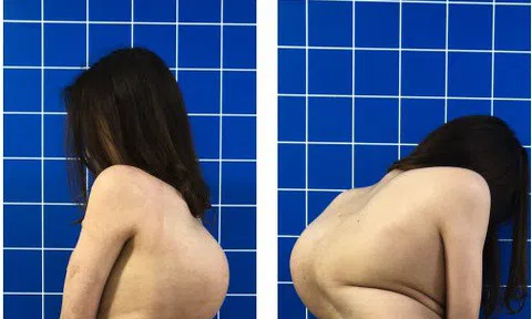 Cô gái trẻ cao thêm 20cm sau ca phẫu thuật loại bỏ ‘khối mai rùa’ trên lưng