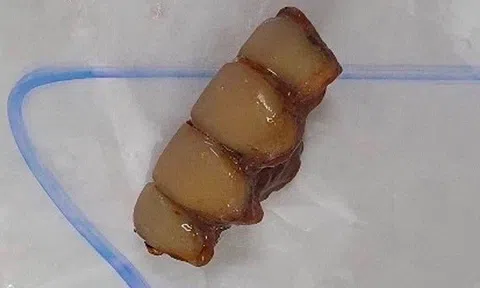 30 phút “truy tìm” răng giả “lạc” vào phế quản