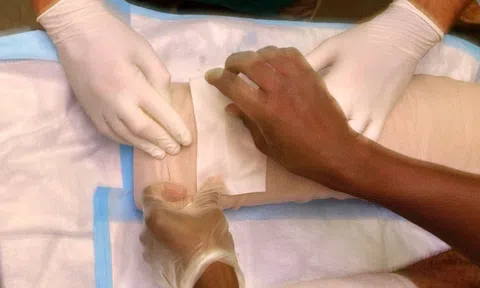 Cụ ông 82 tuổi bị cưa nhầm chân khi phẫu thuật