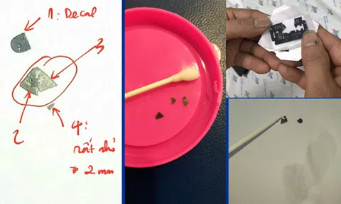 Bé 15 tháng tuổi nuốt 7 mảnh dao lam vào bụng