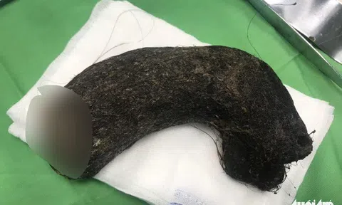 Búi tóc nặng gần 1 kg trong bụng bé gái 11 tuổi