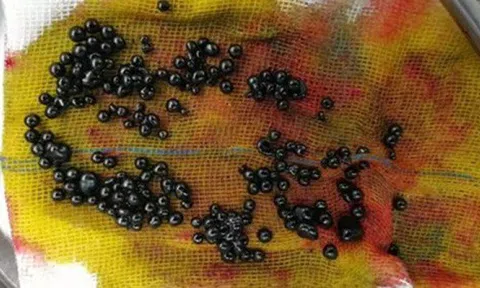 Bé trai 15 tuổi có hơn 100 viên sỏi mật đen bóng như “ngọc trai” chỉ vì món ăn nhiều trẻ em yêu thích