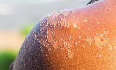 Khi da bị cháy nắng, tuyệt đối không làm những điều sau