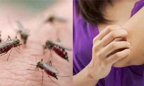 Lý do thú vị vì sao bạn thường xuyên bị muỗi đốt hơn người khác