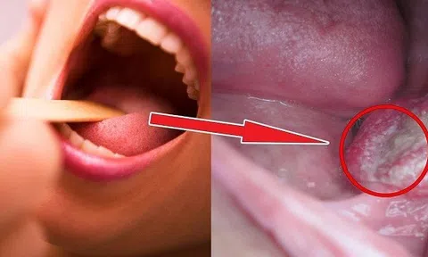 7 dấu hiệu cơ bản cảnh báo ung thư sớm, chớ dại bỏ qua