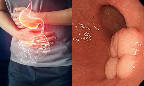 Còn giữ 3 thói quen xấu này đừng hỏi vì sao ung thư dạ dày lại tìm đến bạn