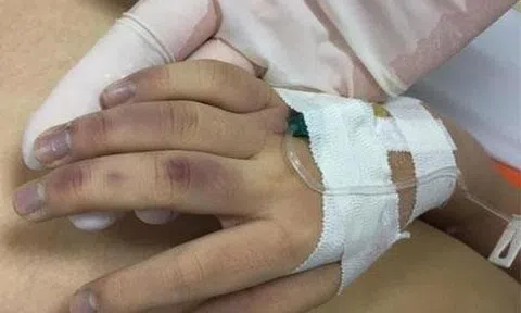 Bé gái bầm tím mặt vì bố "lỡ tay" khi dạy học: Cần khống chế cảm xúc!