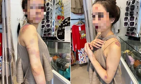 Vụ người vợ bị chồng đánh đập dã man ở Yên Bái: Hội LHPN tỉnh đề nghị xử lý nghiêm