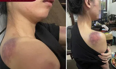 Truy tìm gã chồng vũ phu tra tấn vợ "thừa sống thiếu chết"