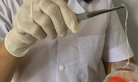 Người đàn ông bị giun rồng ký sinh trong đùi do sở thích ăn tiết canh và đồ tái sống