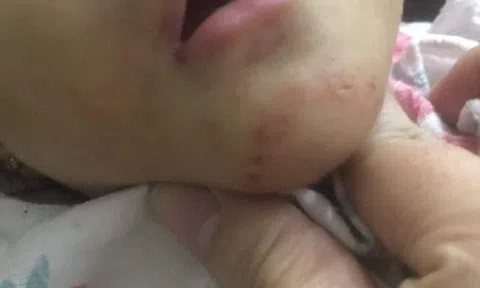 Vụ bé gái 16 tháng tuổi nghi bị mẹ nuôi bạo hành ở Hải Phòng: Công an vào cuộc