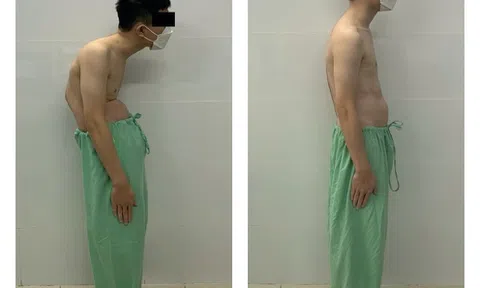 Phẫu thuật thành công cho bệnh nhân gãy trật đốt sống