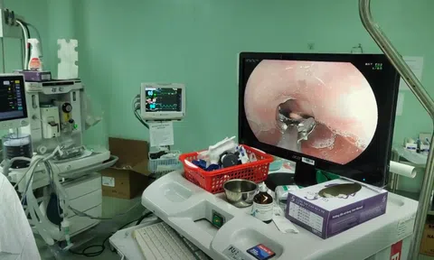 5 phút nội soi cấp cứu thành công bệnh nhân Covid-19 hóc viên thuốc
