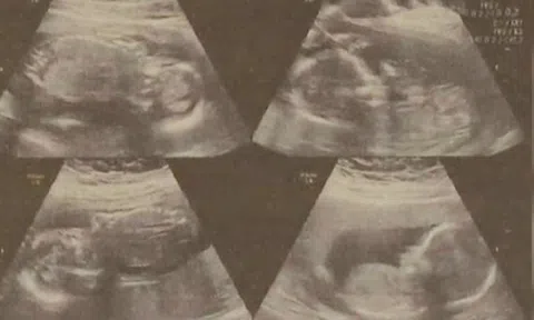 Cô gái sinh 2 con cách nhau 4 ngày, vẫn còn 2 thai nhi trong bụng