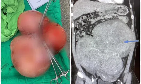 Nữ bệnh nhân 35 tuổi có khối u xơ tử cung nặng 5,5kg