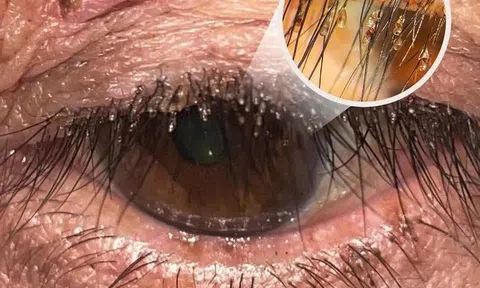 Đi khám vì ngứa mắt, phát hiện rận mu bám chi chít trên lông mi 
