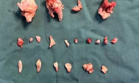 Kinh hoàng: Phát hiện khối u quái chứa 24 chiếc răng trong bụng thiếu nữ 18 tuổi