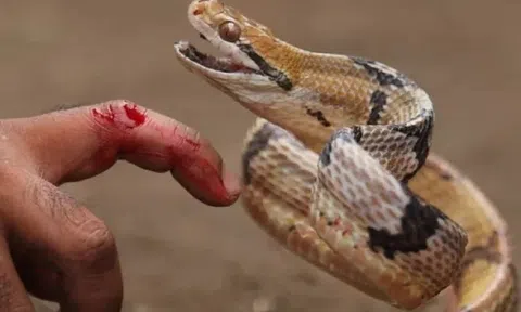 Cứu sống ngoạn mục bệnh nhân bị rắn hổ mang cắn trong tình trạng nguy kịch