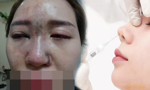 Cô em gái dại dột tiêm filler mũi tím đen cả mắt, chị gái rầu rĩ cầu cứu MXH