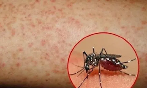 Ghi nhận một trường hợp trẻ tử vong do bệnh sốt xuất huyết Dengue