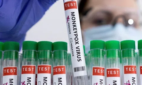 Dạng đậu mùa khỉ đặc biệt nghiêm trọng ở bệnh nhân HIV giai đoạn cuối
