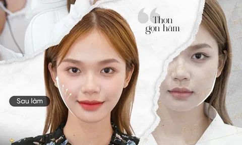 Giải mã ý kiến trái chiều về Vline Perfect thon gọn hàm