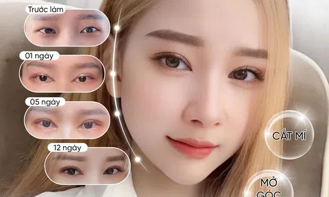 Cắt mí - tiểu phẫu đơn giản đem lại hiệu quả thẩm mỹ cao