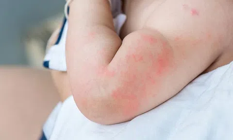 Trẻ bị phát ban nhưng không sốt là do đâu?