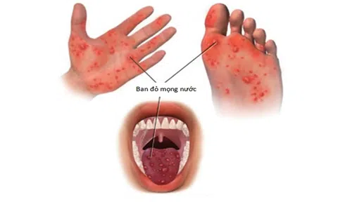 Dấu hiệu trẻ bị chân tay miệng và cách chăm sóc