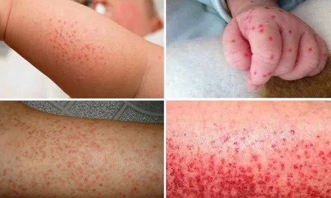 Sốt xuất huyết ở trẻ em có nguy hiểm không?
