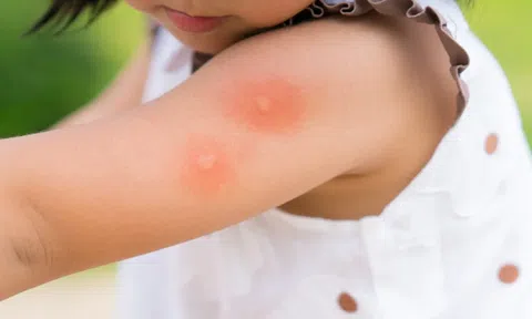 Biểu hiện sốt xuất huyết nặng ở trẻ em
