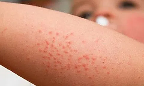 Sốt xuất huyết ở trẻ em kéo dài bao lâu?