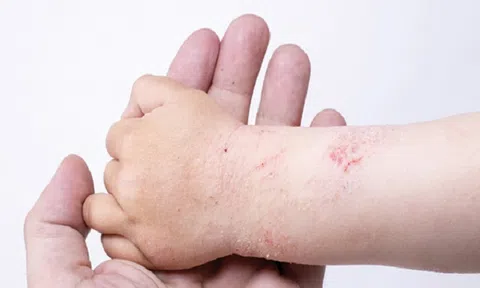 Dấu hiệu sốt xuất huyết ở trẻ em như thế nào?
