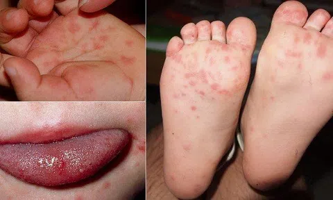 Dấu hiệu bệnh chân tay miệng ở trẻ em là gì?