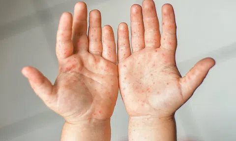 Trẻ em bị bệnh tay chân miệng có lây không?