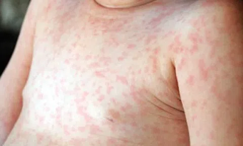 Sốt siêu vi và sốt xuất huyết ở trẻ khác nhau như thế nào?