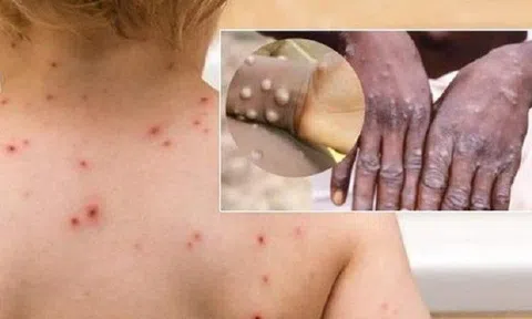 Vì sao 99% số người mắc bệnh đậu mùa khỉ ở Canada là nam giới?