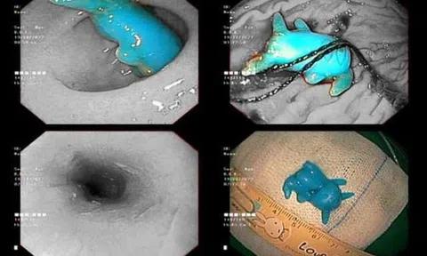 Đồ chơi Pikachu kẹt trong thực quản bé trai 6 tuổi