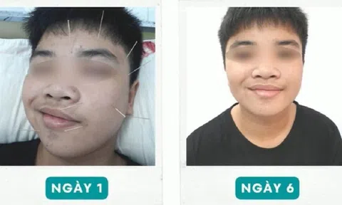 Nam sinh lớp 10 liệt nửa mặt vì trúng "khẩu nhãn oa tà"