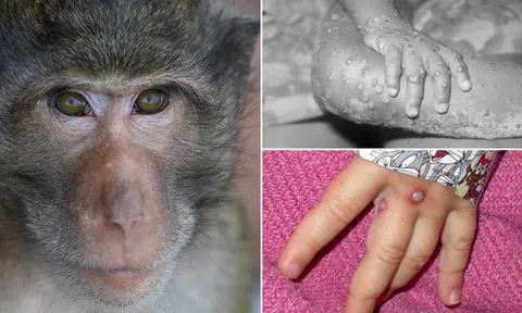 Vì sao không nên quá hoang mang về căn bệnh đậu mùa khỉ?
