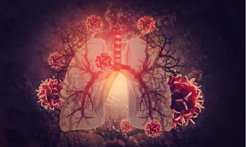 Phòng tránh viêm phổi nặng ở trẻ do bội nhiễm vi khuẩn sau mắc Adenovirus