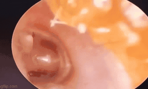 Khoảnh khắc bác sĩ loại bỏ kiến ​​lửa từ bên trong tai bé gái