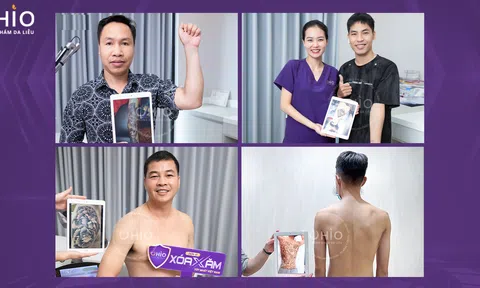 Hình ảnh kết quả Xóa xăm không sẹo bảo toàn nền da với phác đồ Pico 3X